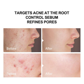 pure.tiful 2% serum on face and back demonstrates versatile acne targeting.