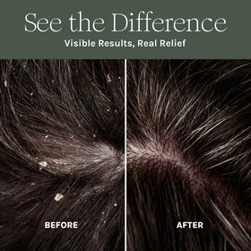 Purist Dandruff Spray ingredients label highlighting aloe, flax oil, and biotin for scalp support.