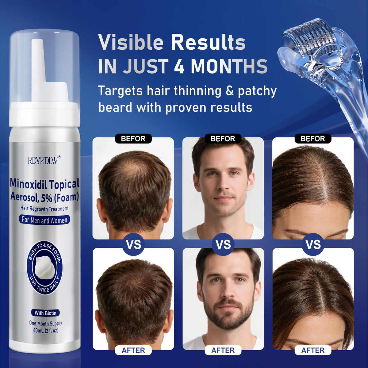 RDVHDLW foam on scalp ideal for daily thinning treatment