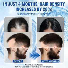 Redyuss Minoxidil packaging box showcases complete kit for consistent routines.