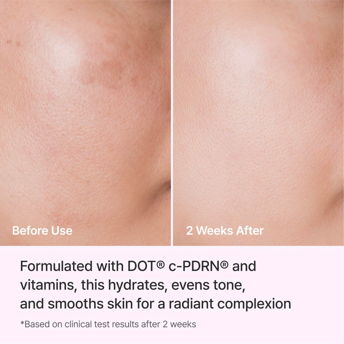 REJURAN application scene illustrating gentle daily use on the face.