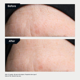 Revision Skincare Revox Line Relaxer under-eye application close-up with precise tip.