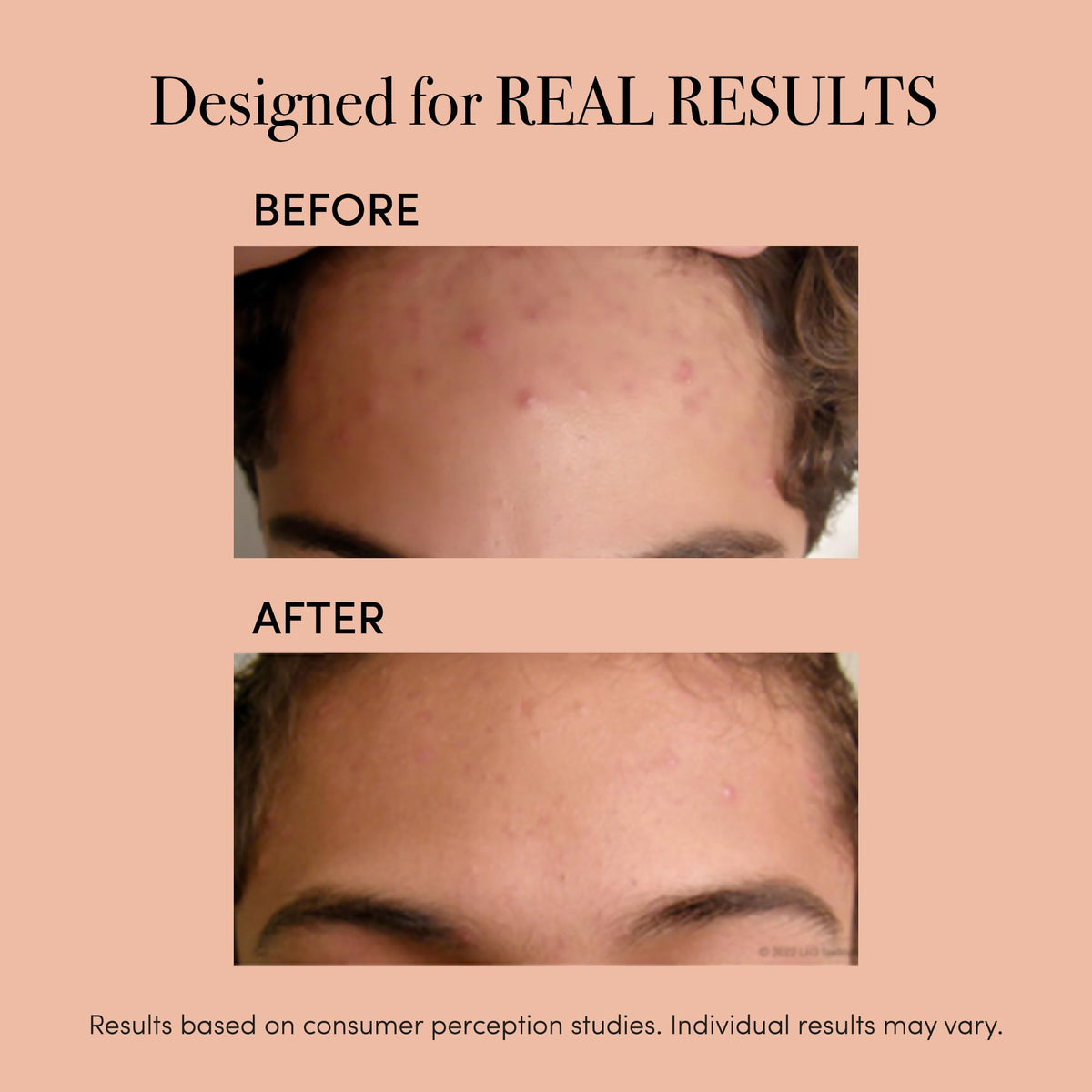 ReVive Clinical Acne Device blue light close-up for pore purification