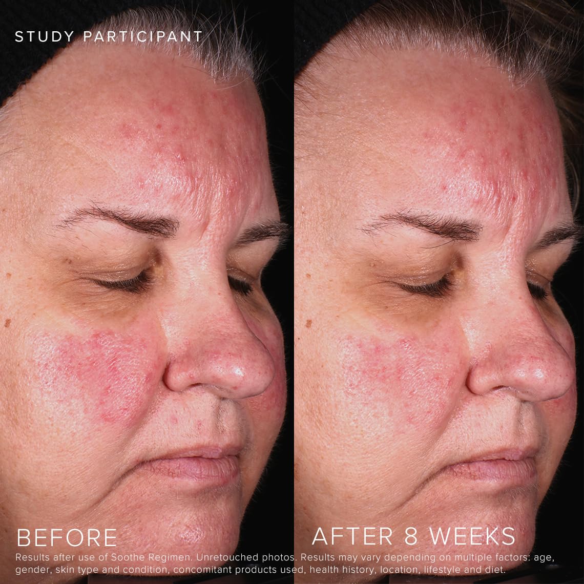 Rodan and Fields Soothe Calming Gel Cleanser after rinse, leaving a refreshed, non-tight sensation for sensitive skin.