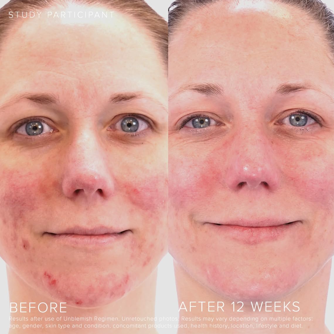 Rodan Fields Unblemish clarity closeup highlighting improved skin texture and clarity.