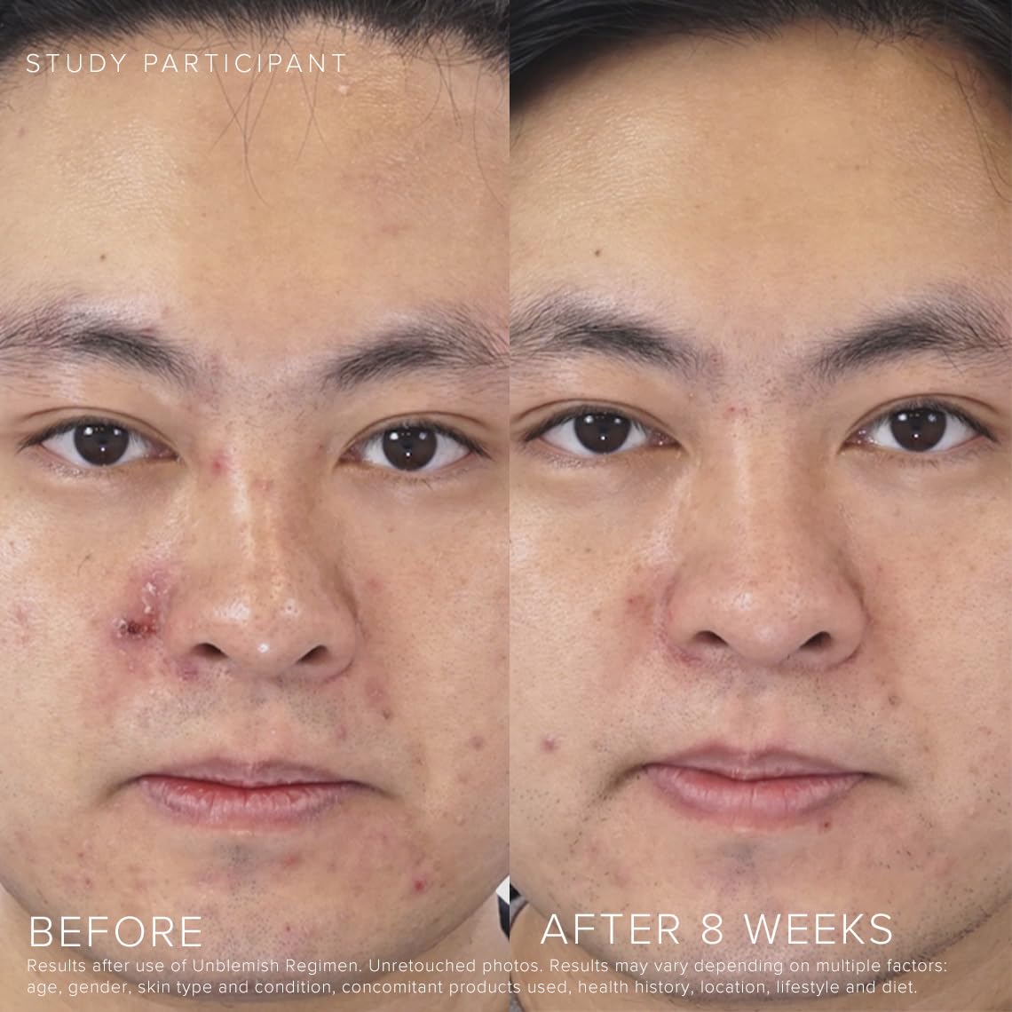 RODAN + FIELDS UNBLEMISH SPF 30 on neck demonstrates protective matte finish for daytime use