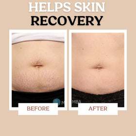 Roe Wellness cream massaged into abdomen for hydration and comfort