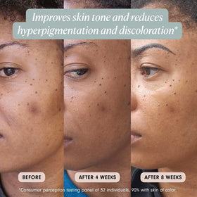 ROSE Ingleton MD FutureBright on skin promotes even tone and brighter appearance.