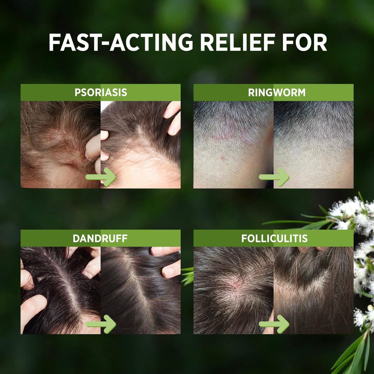 Roycederm Leave-in Scalp Care on dry, flaky areas ready for daily use.