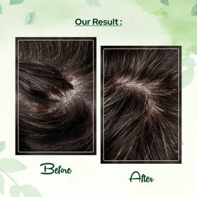 Close-up of ingredients highlighting salicylic acid and coal tar