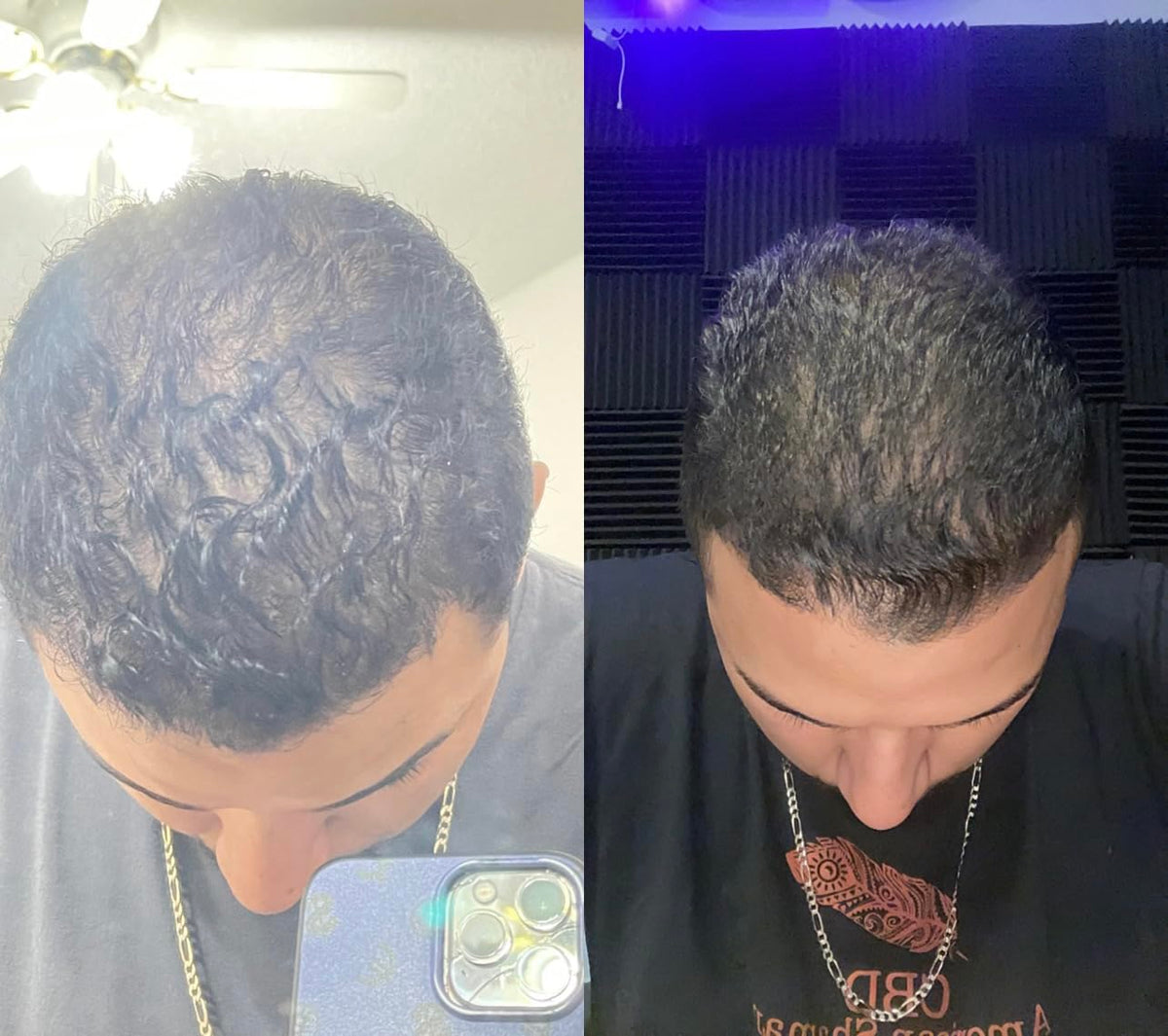 Gentle massage on damp hairline post shower using serum.