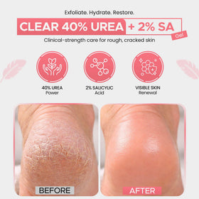Scientific Solutions Global CLEAR 40 +SA Gel hand application smooths rough skin.