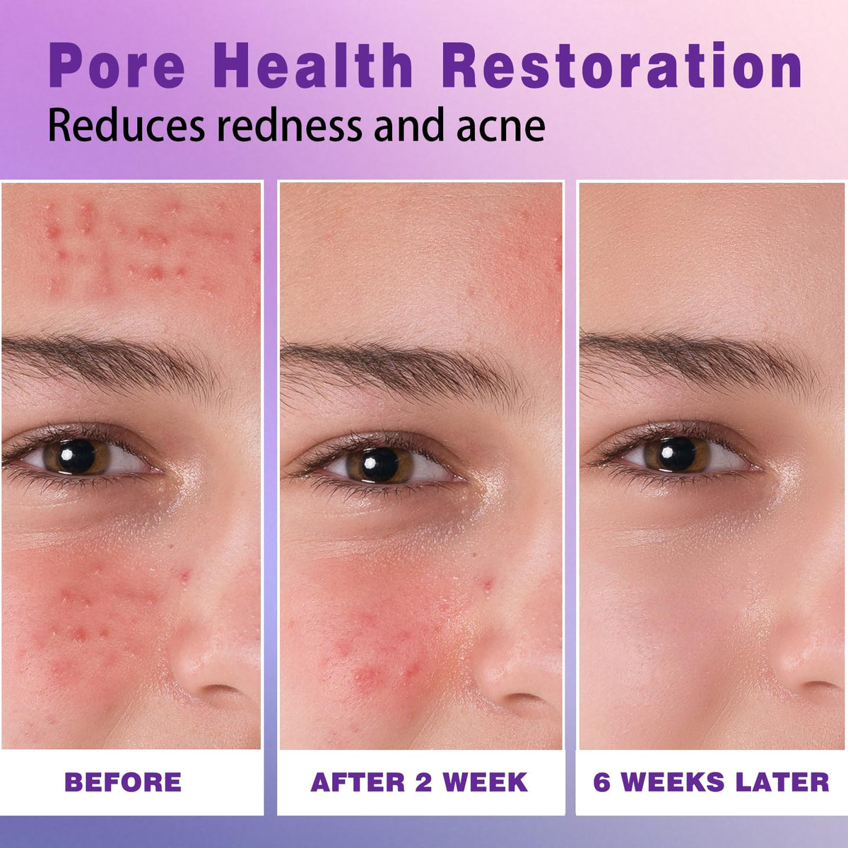 Sefralls Azelaic Acid Cream 1oz tube ready for daily use.