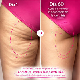 SHAEIO Candela cellulite smoothing on legs and abdomen.