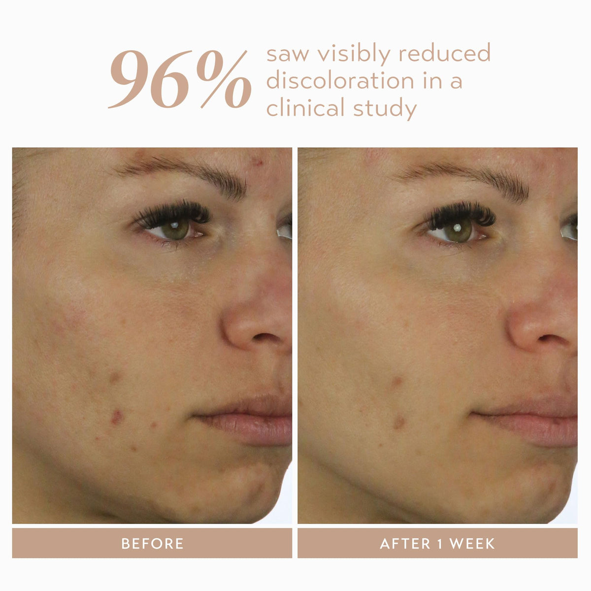 Hyaluronic acid and panthenol boost surface hydration in the serum