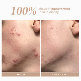 Oat kernel extract in Rescue Serum promoting gentle hydration