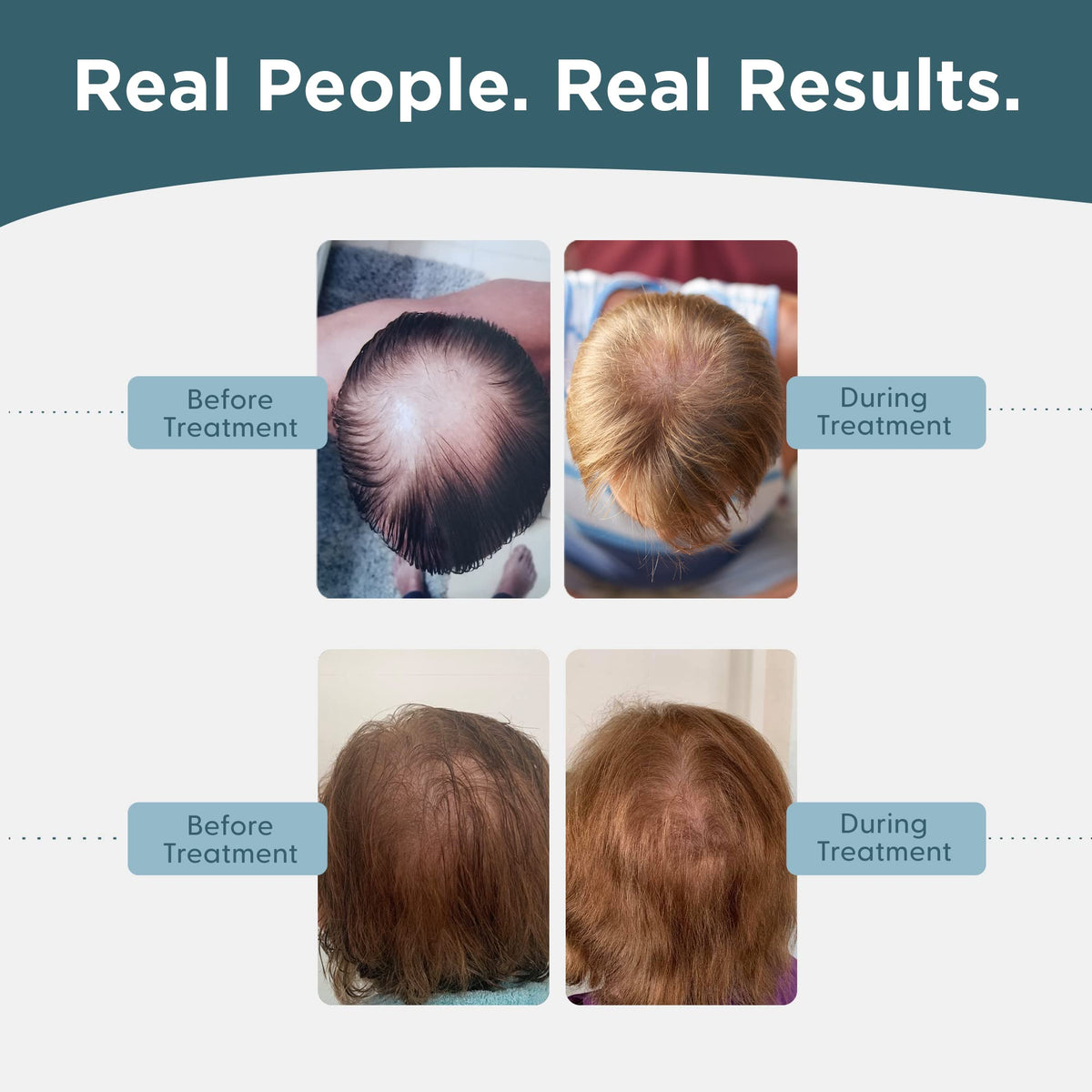 Shapiro MD Minoxidil clear-solution bottle emphasizes easy daily use.