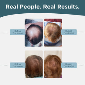 Shapiro MD Minoxidil clear-solution bottle emphasizes easy daily use.