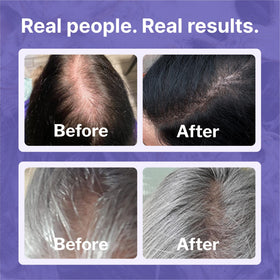 Applying Shapiro MD Minoxidil to thinning scalp area, a practical use case