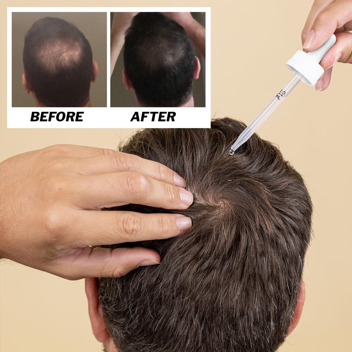Shapiro MD Regrowth Kit complete box display featuring all-in-one thinning solution