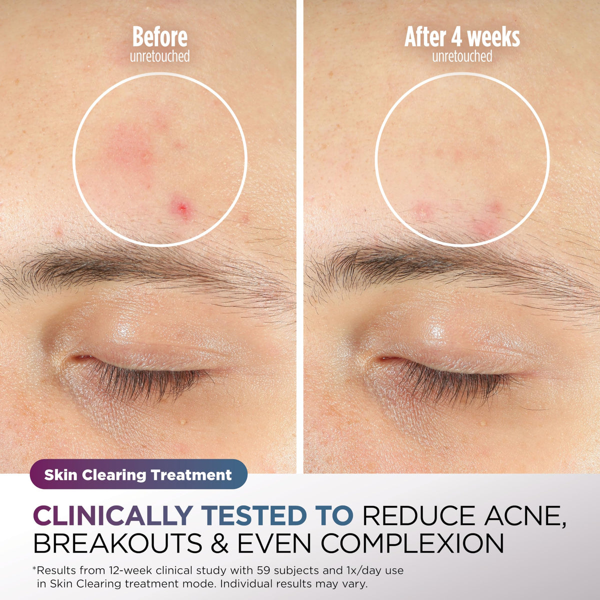 Shark CryoGlow skin clearing treatment supports blemish reduction