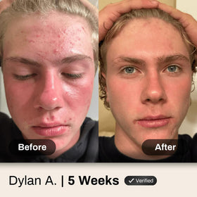 Shield Dermatologist-endorsed skincare for clear balanced skin