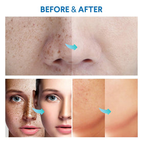 Sielkin application area usage on face, neck, legs, underarms.
