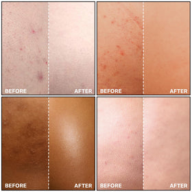 Unisex SKINBOSS body acne care product suitable for both genders