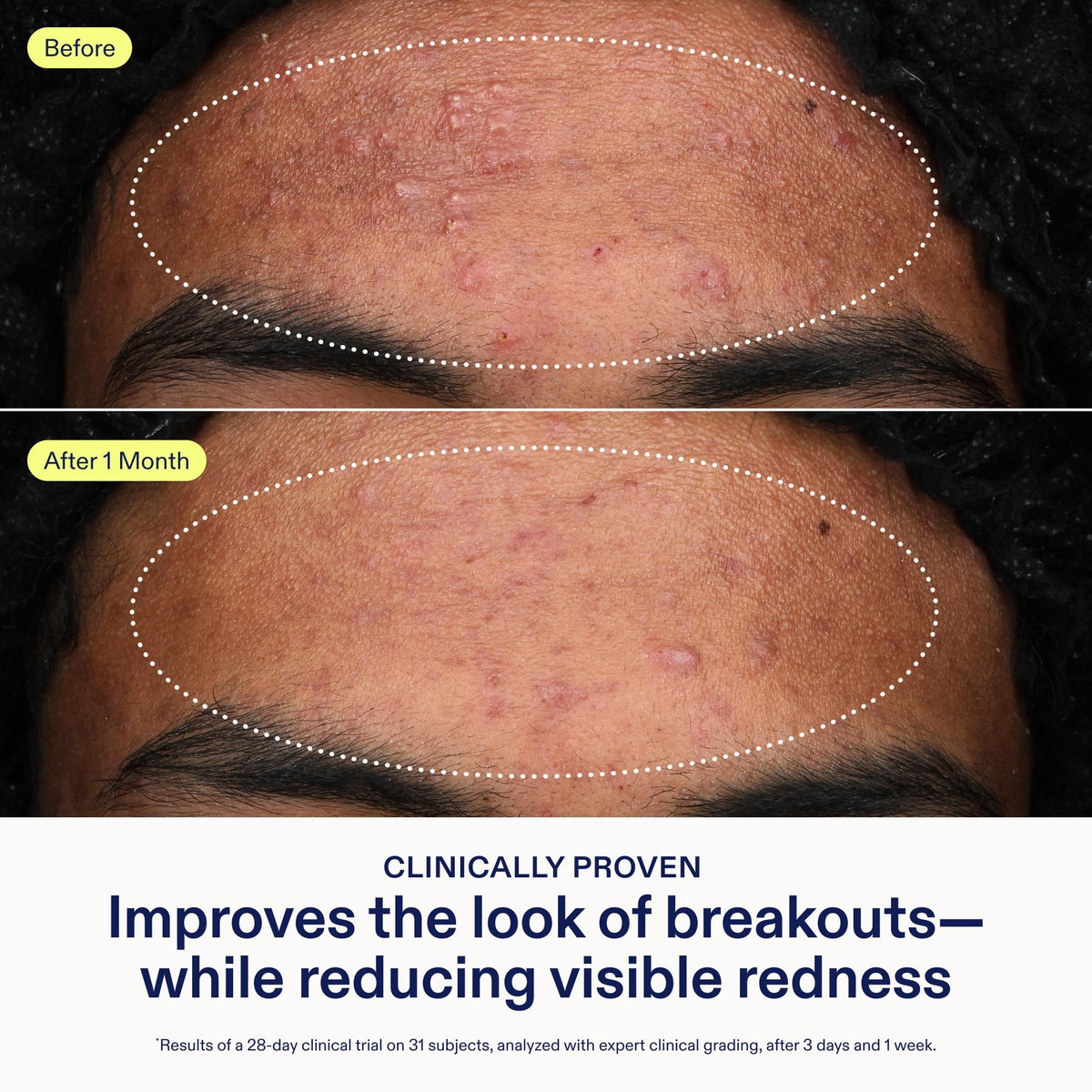 Applying Skinfix Adapinoid Gel to skin for a nightly routine.
