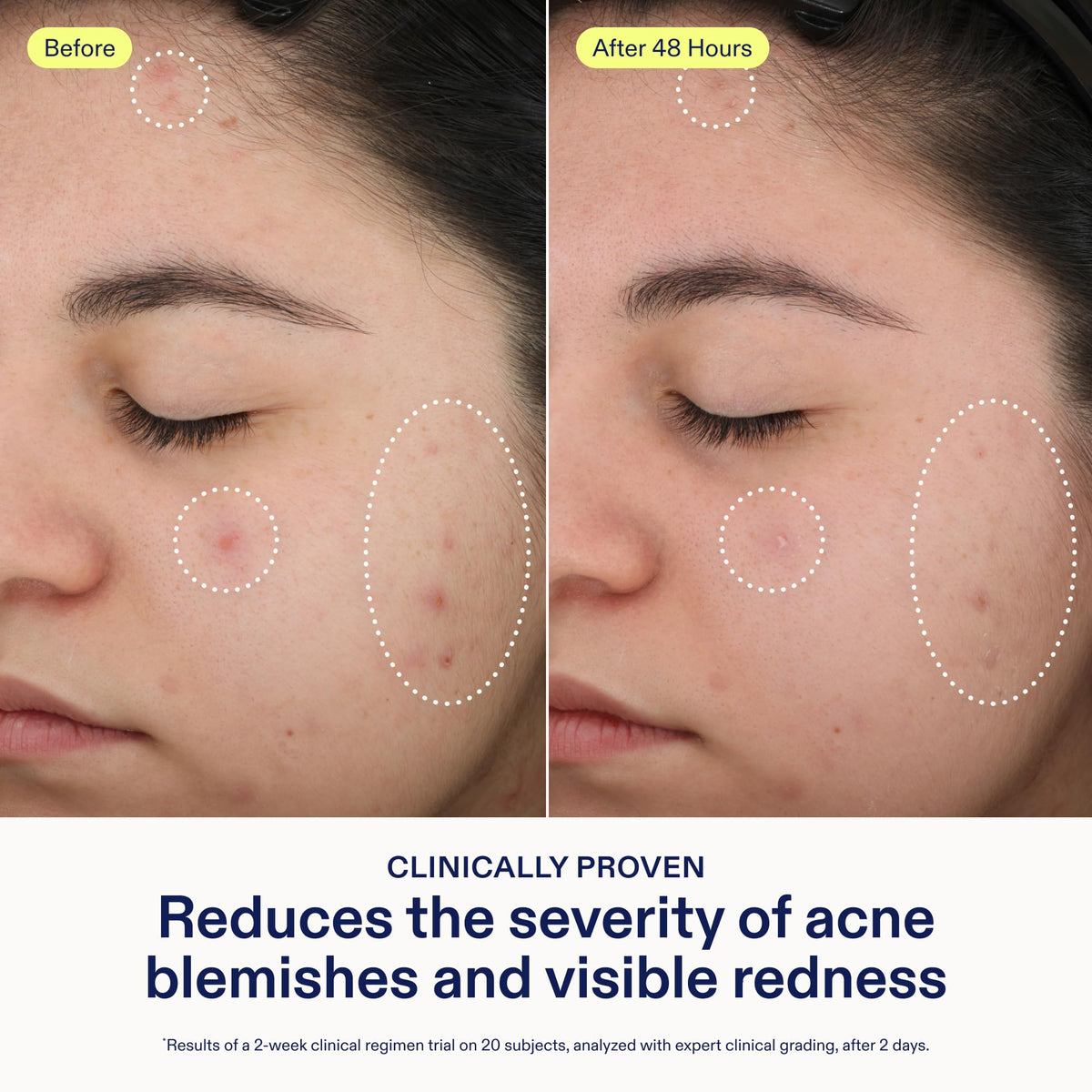 Skinfix azelaic acid visibly reduces redness for more even tone.
