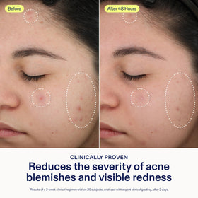 Skinfix azelaic acid visibly reduces redness for more even tone.