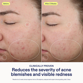 Skinfix salicylic acid clears pores and helps prevent blackheads.