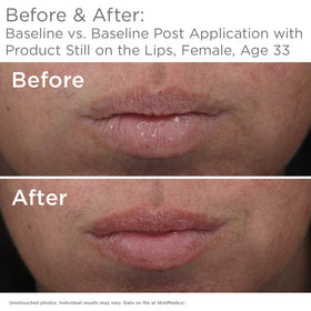 Close-up of SkinMedica HA5 lip system ingredients hinting at hydration benefits.