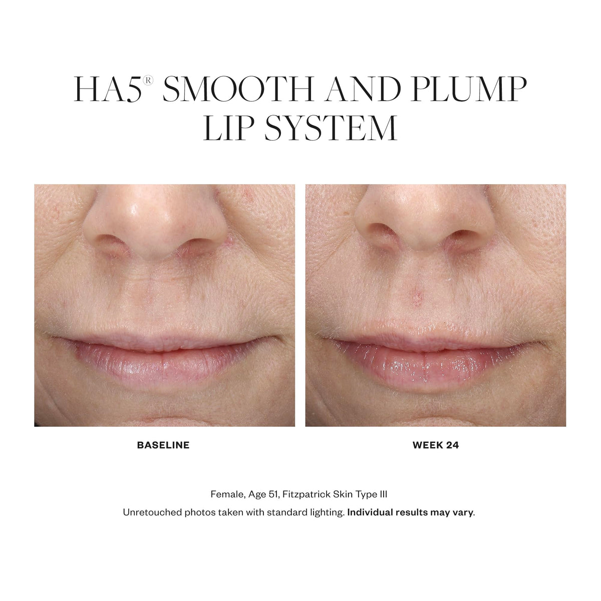 SkinMedica HA5 lip system applied to lips for subtle fullness and smooth texture.