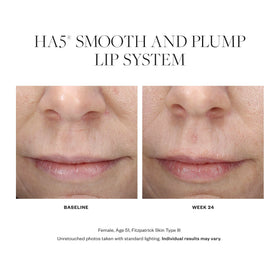 SkinMedica HA5 lip system applied to lips for subtle fullness and smooth texture.