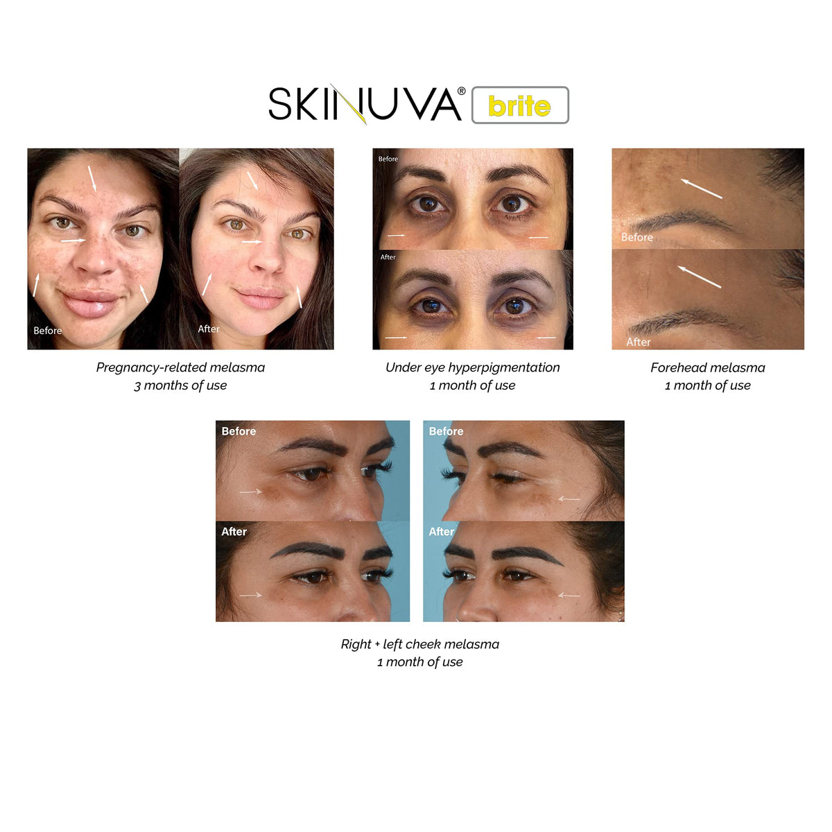 Skinuva Brite label close-up emphasizing growth factors and tranexamic acid.