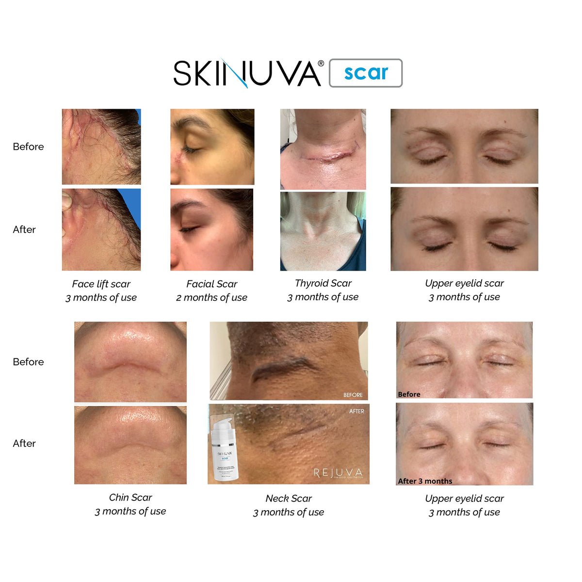 Skinuva Next Gen Scar Cream on skin demonstrates smooth application.