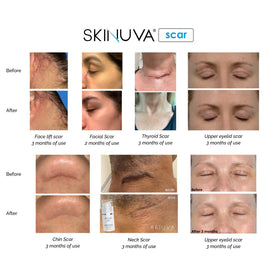 Skinuva Next Gen Scar Cream on skin demonstrates smooth application.
