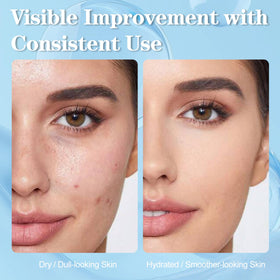 SKSOYT hyaluronic-acid serum bottle highlighting hydration and a dewy glow