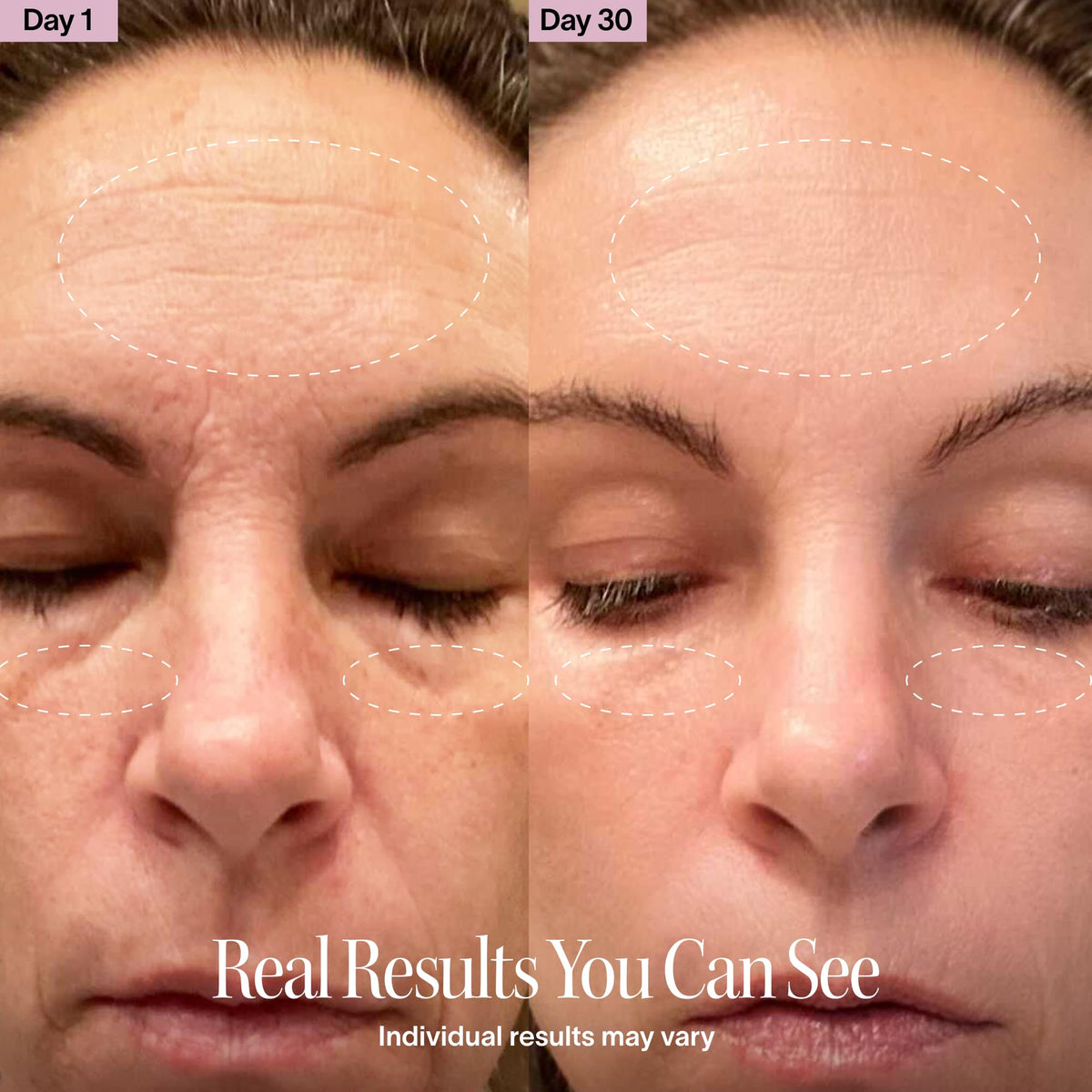 Solawave targeted treatment on forehead and cheeks for smoothing.