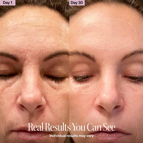 Solawave targeted treatment on forehead and cheeks for smoothing.