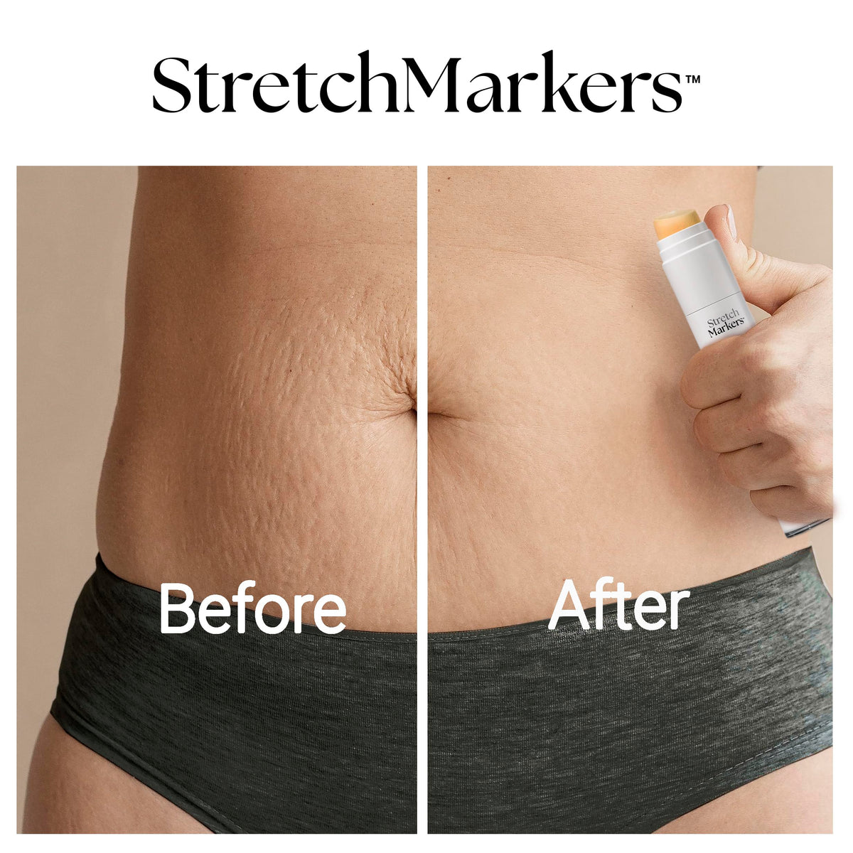 StretchMarkers Therapy Cream routine in daily skincare for post-weight-change skin support