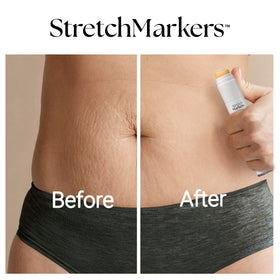 StretchMarkers Therapy Cream routine in daily skincare for post-weight-change skin support