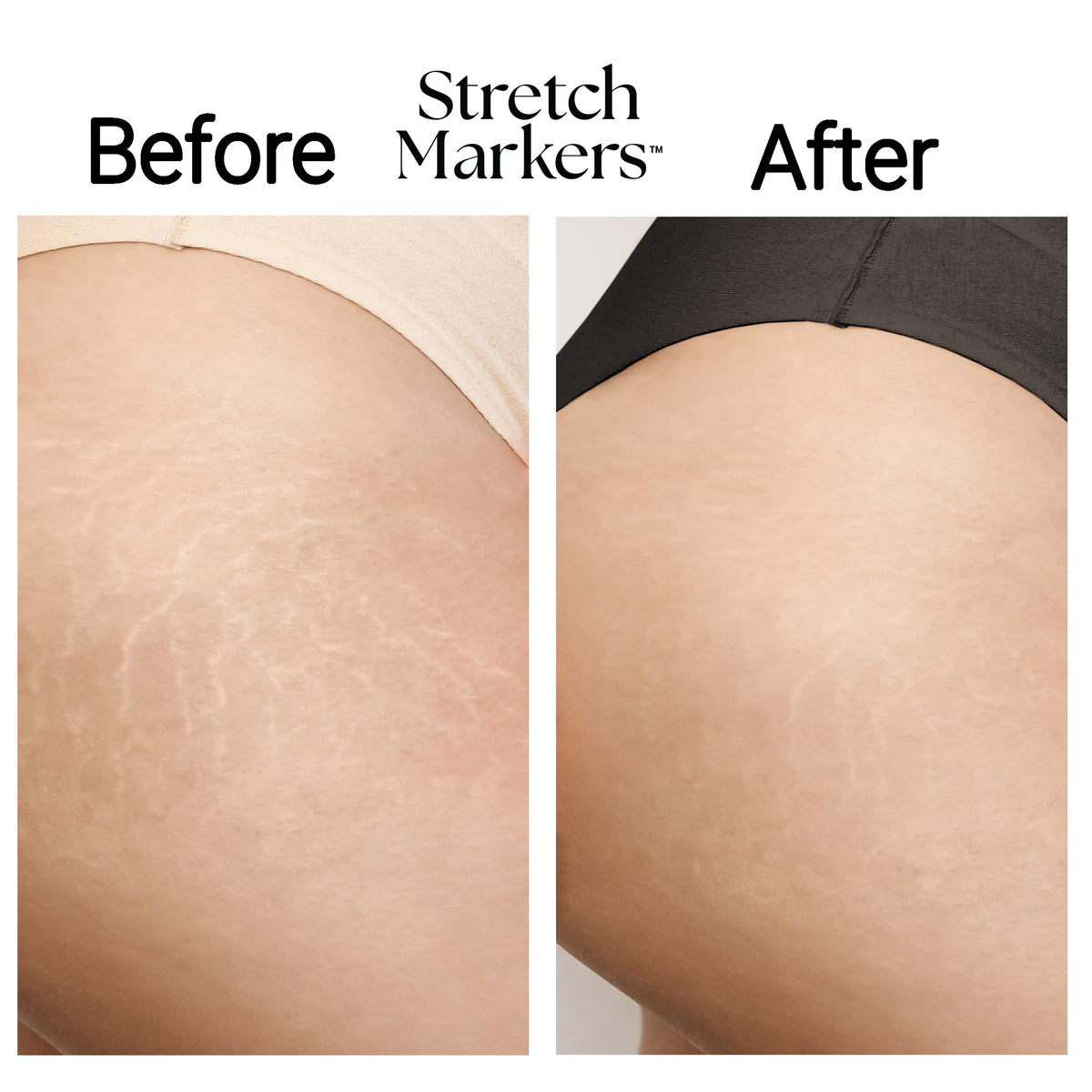 StretchMarkers Therapy Cream deep hydration with hyaluronic acid microspheres for plumper skin