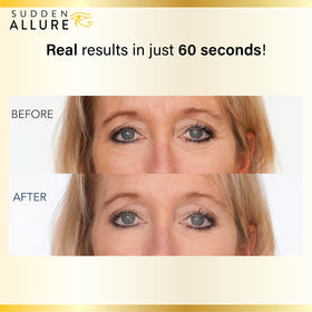 SuddenAllure crow's feet tightening close-up shows firming around the eyes.