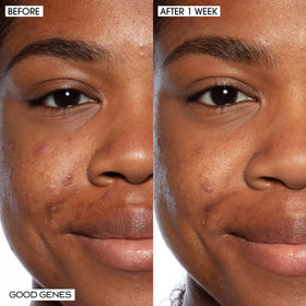 Sunday Riley Good Genes bottle closeup, illustrating exfoliation for clearer-looking skin.