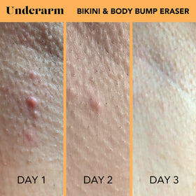 SweetSpot Labs azelaic acid ingredient close-up for bump targeting