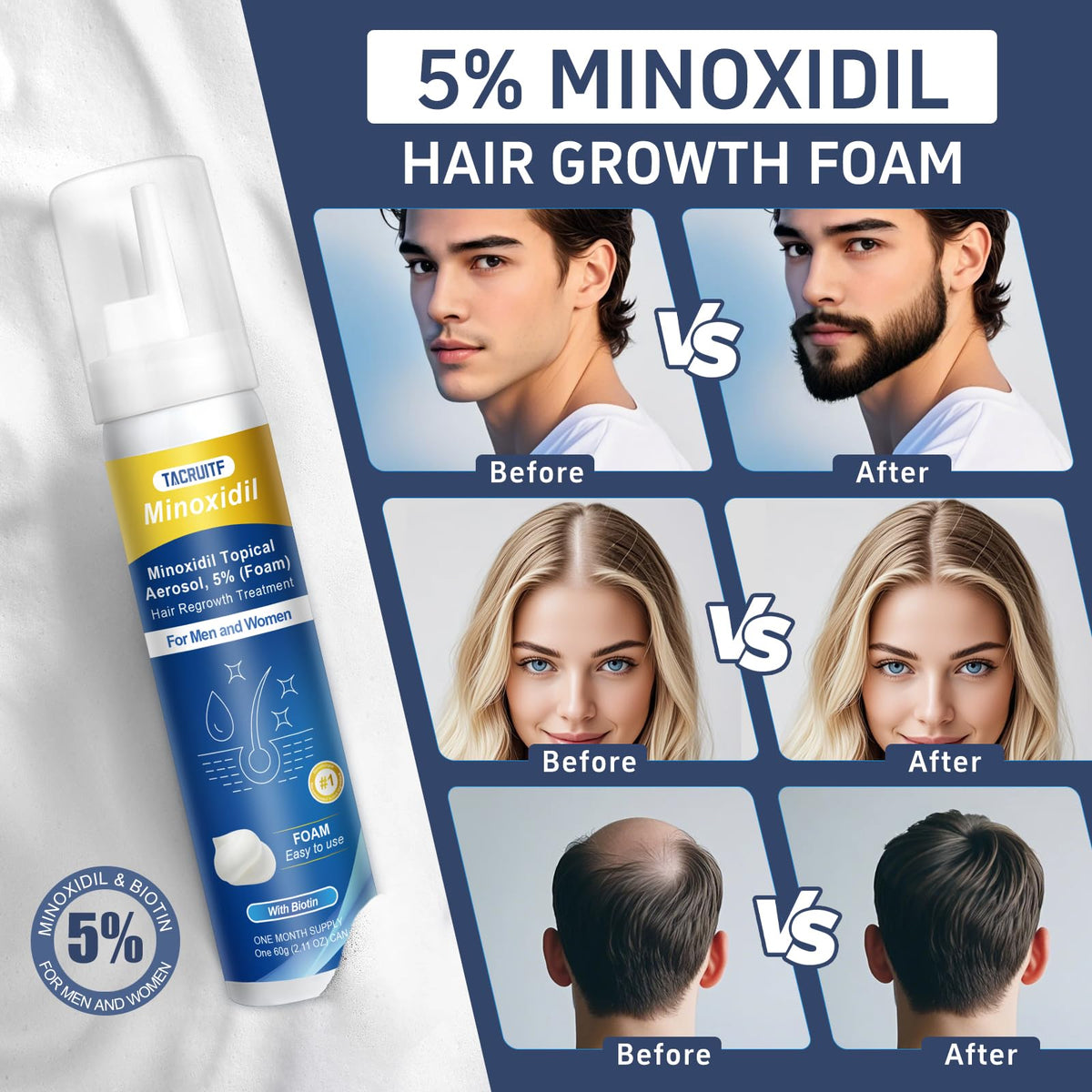 Tacruitf Minoxidil Foam dispenser tip ready for scalp application.