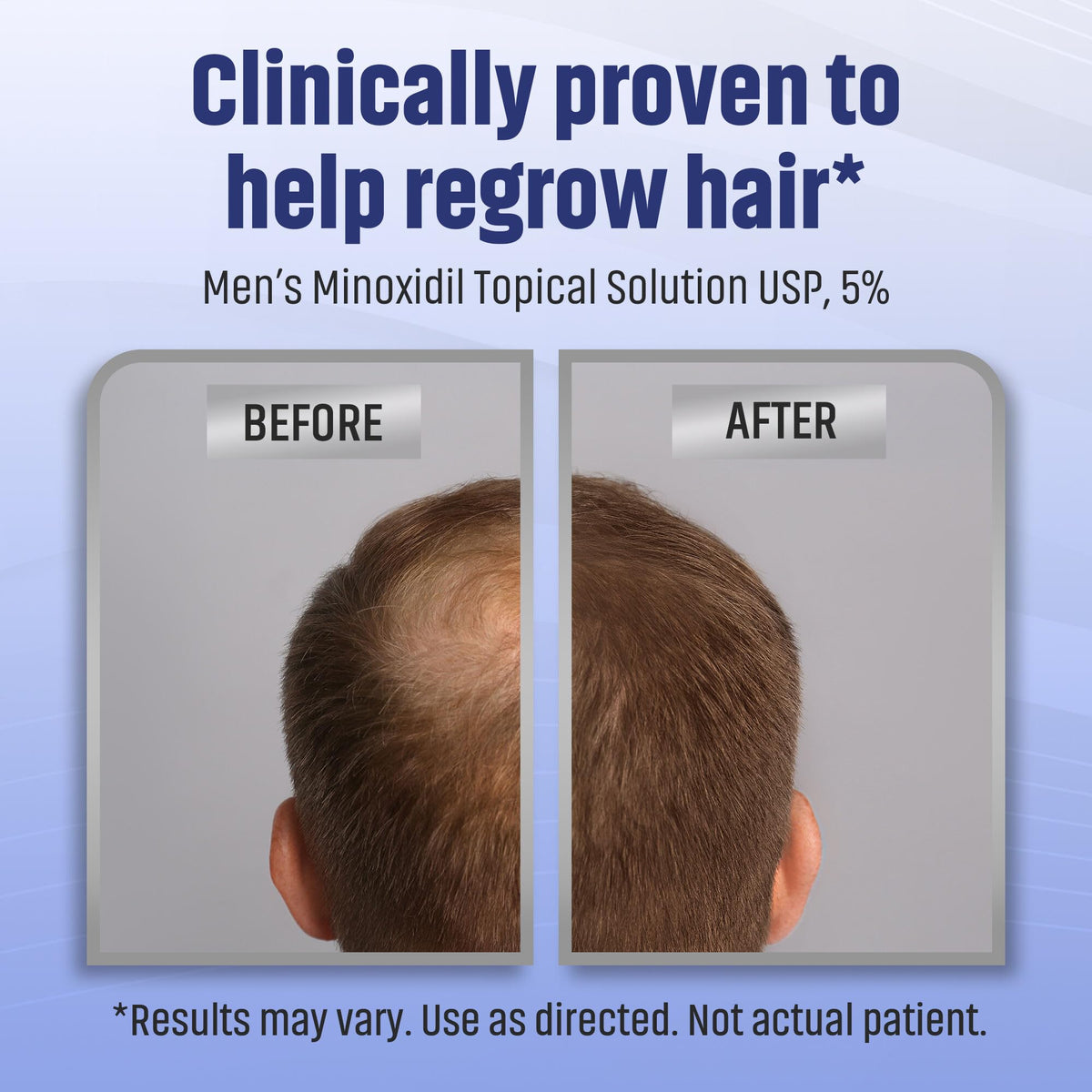 Vertex thinning area showing TARO Minoxidil treatment focus