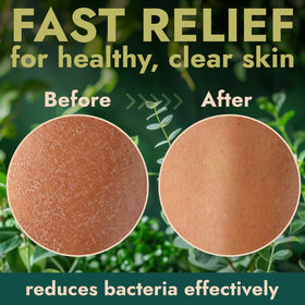 Terramed Just Think Comfort targets back acne and skin irritation for clearer pores.